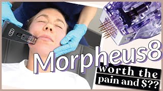 TREATMENT RECOVERY AND INITAL REVIEW OF THE MORPHEUS8 ANTIAGING RADIO FREQUENCY MICRONEEDLING TX [upl. by Slohcin180]