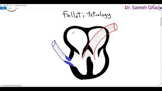 Systemic pathology 77  congenital heart diseases [upl. by Cutcliffe]