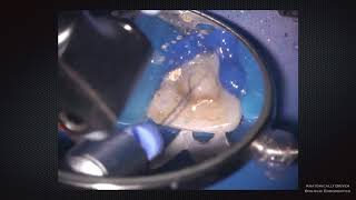 Video Dr Jorge Vera Puebla Mexico XP endo Finisher R [upl. by Suoicserp]