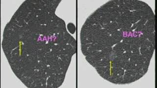 CT Guided Lung Biopsy  CT Guided Needle Biopsy [upl. by Melc]