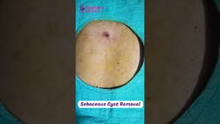 Sebaceous Cyst Removal  Singhania skin clinic Raipur [upl. by Edan]