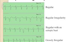 Basic Dysrhythmias [upl. by Henryetta319]