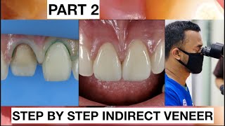 Step by Step 2 Indirect Veneer with Discoloration Tooth Part 2  General Dentist Griya RR [upl. by Maible]