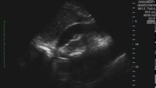 Cardiac Tamponade Ultrasound JETem 2016 [upl. by Vanderhoek]