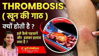 What is Thrombosis Whos at Risk and How to Prevent Blood Clots  Dr Shruti Toshniwal [upl. by Anika771]