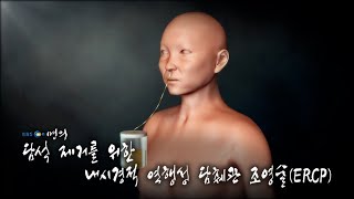 명의 의학백과📖 담석 제거를 위한 내시경적 역행성 담췌관조영술ERCP [upl. by Gleeson]