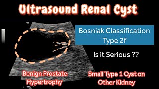 Renal Cyst Type 2f Bosniak Classification  Ultrasound  other Kidney Type 1 Small Cyst  Treatment [upl. by Vaios425]