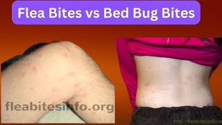 Flea Bites vs Bed Bug Bites  How to Tell Which One You Have [upl. by Herries]