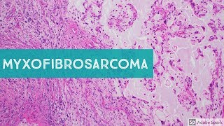 Myxofibrosarcoma 101Explained by a Sarcoma Pathologist [upl. by Theressa1]