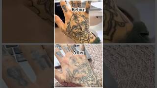 Healing process for laser tattoo removal [upl. by Sherborn]