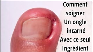 Comment soigner un ongle incarné naturellement [upl. by Sisxela]