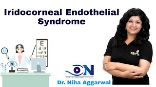 Iridocorneal Endothelial Syndrome  Dr Niha Aggarwal [upl. by Bullion]