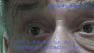 Progressive Supranuclear Palsy [upl. by Jacqueline]