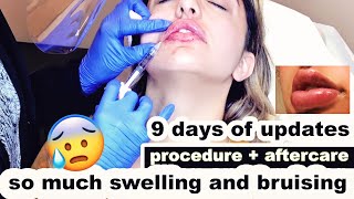 LIP FILLERS  First time tips for faster healing [upl. by Berliner]