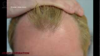 FUE 2207 Ufs MeDiKemos Hair Transplantation FR [upl. by Oneill423]