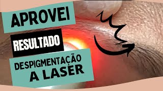 Resultado Despigmentação de Sobrancelhas a Laser  Remoção de Tatuagem a Laser [upl. by Lavina781]