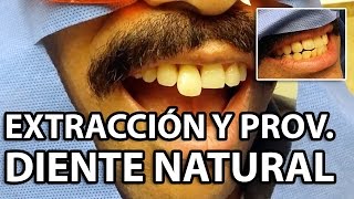 DIENTE NATURAL como PROVISIONAL 👅 FERULIZADO dentaltip dental [upl. by Jeb]