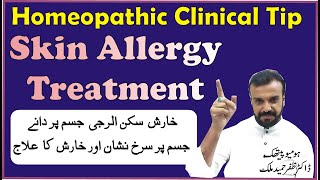 Skin Care Treatment by Homeopathic Dr Zafar Hameed Malikخارش کا علاج Kharish ka ilaj [upl. by Robers]