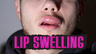 CAUSES OF SWOLLEN LIPS AND HOW TO TREAT [upl. by Enriqueta]