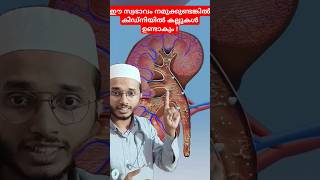 Kidney stone formation Dr Muhammed Shibili healthtips [upl. by Akemrehs]