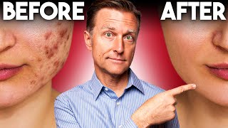 The FASTEST Way to Rid Acne  Dr Berg [upl. by Ymmak]