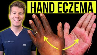 Doctor explains how to recognise and treat HAND ECZEMA dermatitis  Causes symptoms amp prevention [upl. by Selie]