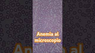 Así se ve la anemia al microscopio hematología anemia laboratorioclinico [upl. by Gnilhsa]