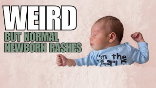 Newborn Baby Rashes on Face and Skin [upl. by Attenohs]