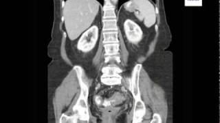 Diverticulitis on CT Scan [upl. by Caine530]