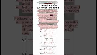 Hyperkalemia after succinylcholine admin [upl. by Etteragram]