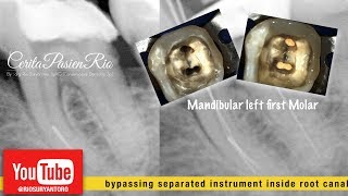 bypassing instrument in endodontic treatment  perawatan akar gigi  endodontist [upl. by Ahseuqram227]