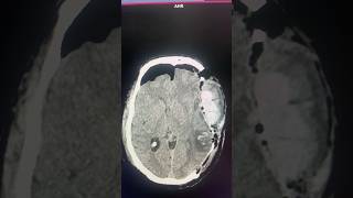 CT Scan Showing Post Oprative EDH anatomy radiology [upl. by Allanson]