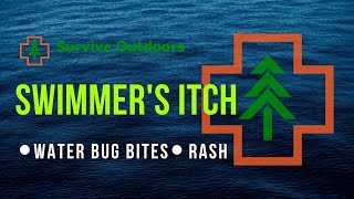 Water Bug Bites  Swimmers Itch vs Sea Lice [upl. by Naginnarb]