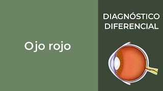 Ojo rojo Diagnóstico diferencial [upl. by Anelagna]