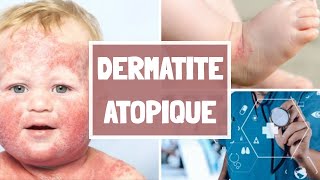 LA DERMATITE ATOPIQUE CAUSES  SYPMTOMES  COMPLICATIONS  TRAITEMENT [upl. by Imre]