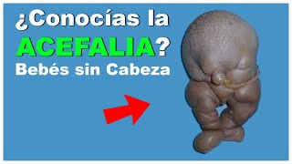 Acefalia  Bebés SIN CABEZA [upl. by Earal]