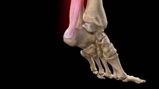 Achilles Tendon Rupture  Complete Anatomy [upl. by Jaala]