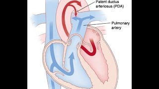 Patent Ductus Arteriosus [upl. by Aciraj]