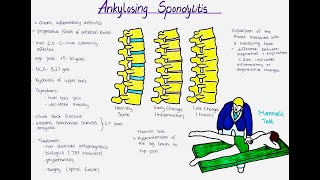 Ankylosing Spondylitis Morbus Bechterew  Etiology Symptoms Diagnosis Pathogenesis Treatment [upl. by Samford]