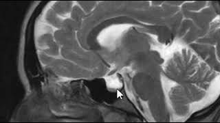 Pseudotumor Cerebri  Brain Scan MRI [upl. by Niela]