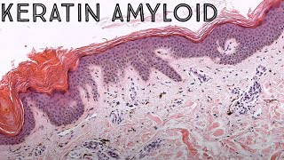 Keratin Amyloid Lichen amyloid vs Macular amyloidosis NOT systemic amyloidosis pathology [upl. by Dorcus]