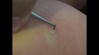 Splinter Removal  Splinter remove from leg [upl. by Florance]