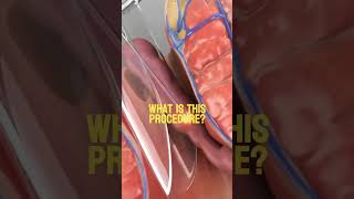 What is this procedure Video credit Prof Dr Sedat Belli YouTube Thanks for this video [upl. by Animsay648]