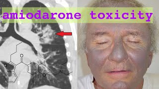 amiodarone toxicity [upl. by Peskoff]