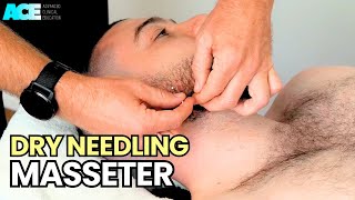 Dry Needling Masseter [upl. by Thorr325]