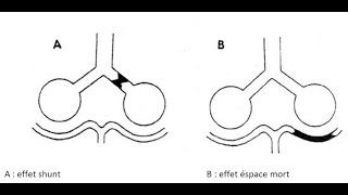 Effet shunt et effet espace mort QUELLE EST LA DIFFÉRENCE [upl. by Yeung885]