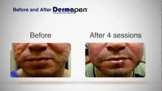 MicroNeedling Before and After  Dermapen® Treatment [upl. by Dallman]