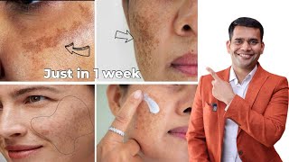 Pigmentation Melasma Dark Spot 100 Working Treatment  Dr Vivek Joshi [upl. by Malek]