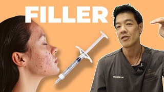 How to Fix ACNE SCARS with Dermal Filler  Dr Davin Lim [upl. by Naujak]