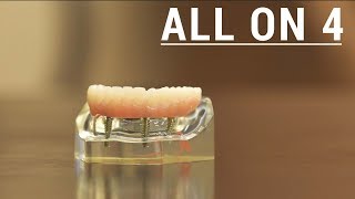 Top 3 questions people ask about AllOn4 Dental Implants [upl. by Ydospahr]